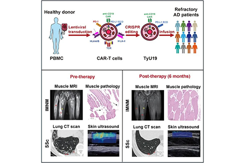 我国学者发表国际首个通用CAR-T治疗成果
